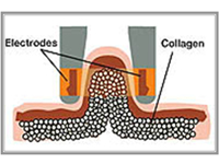 Cellulite تكهف جسم تحت أحمر يشكّل تجهيز مع ثنائيّ قطب rf/LPG فراغ بكرة