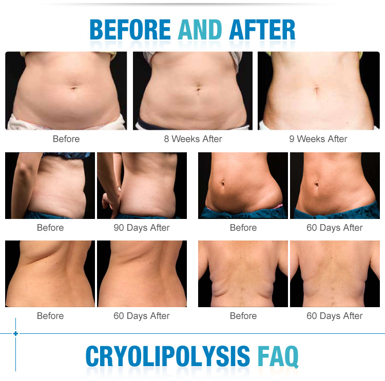 Best seller vertical fat freezing cryolipolisis coolsculpting cryolipolysis machine